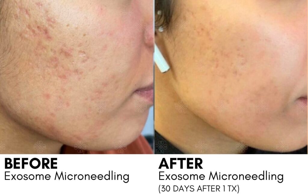 EXOSOME MICRONEEDLING B_A WITH CAPTION