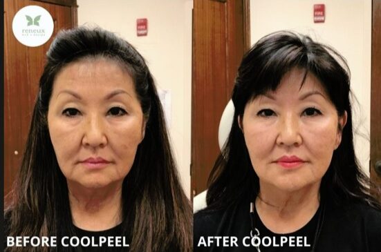 BEFORE-AFTER-COOLPEEL